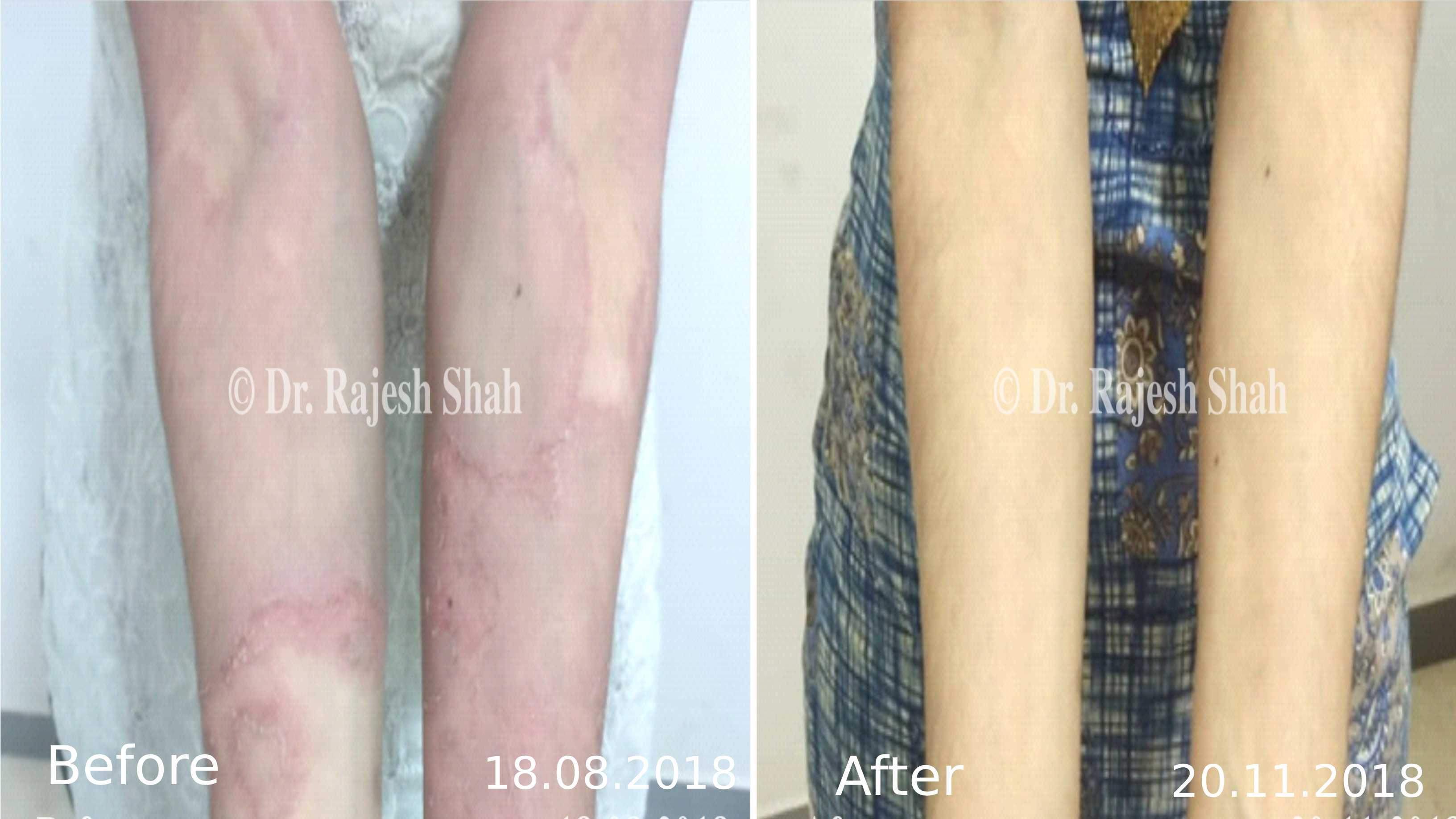 Psoriasis Before and After Case Photo