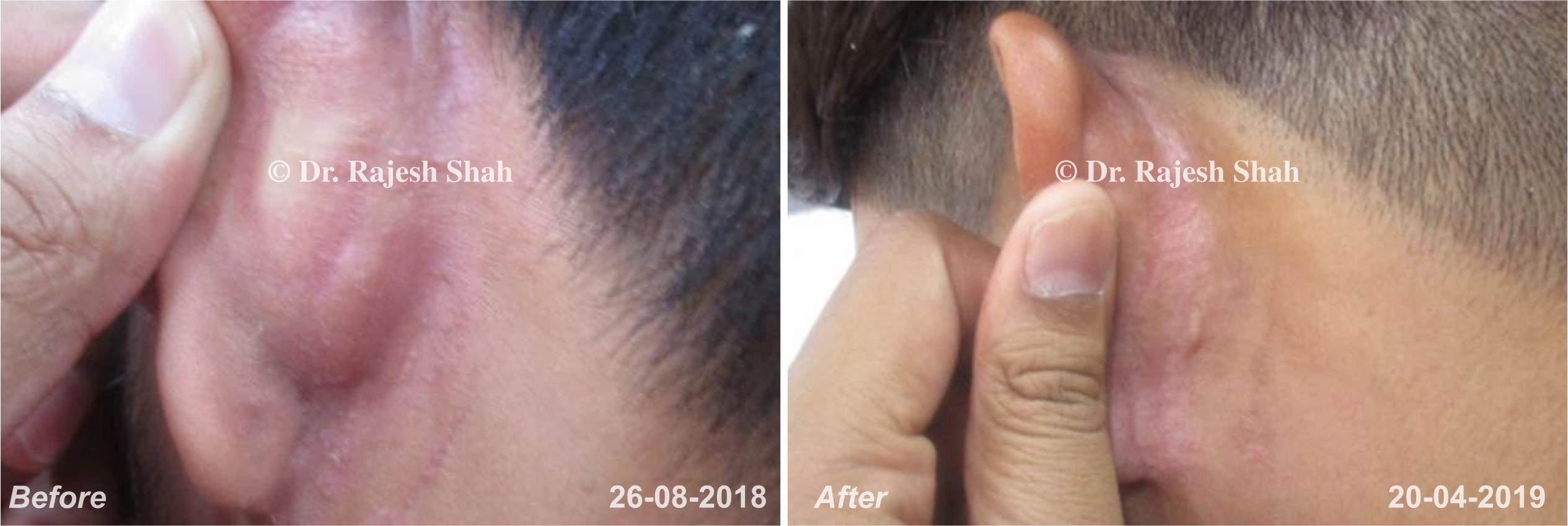 Psoriasis Before and After Case Photo