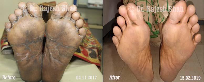 Psoriasis Before and After Case Photo