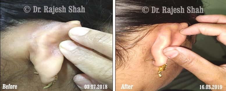 Psoriasis Before and After Case Photo