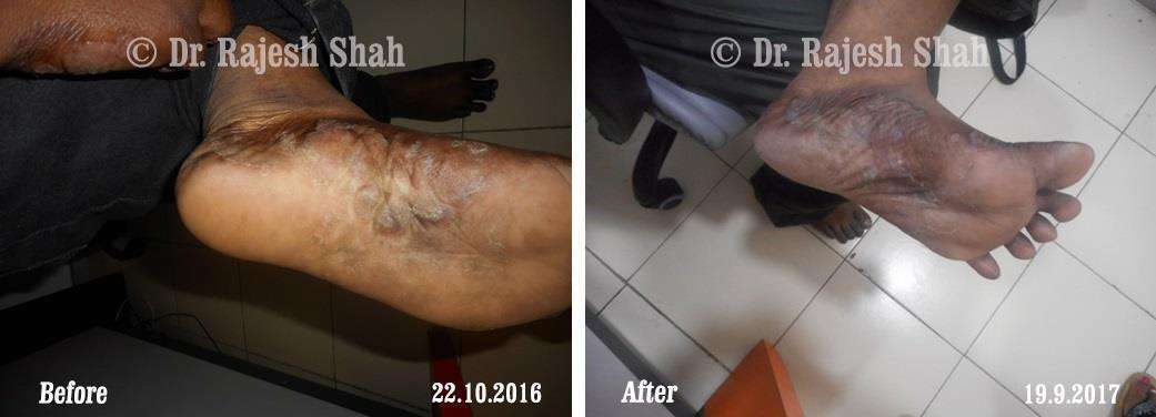 Psoriasis Before and After Case Photo