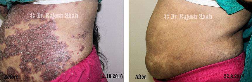 Psoriasis Before and After Case Photo