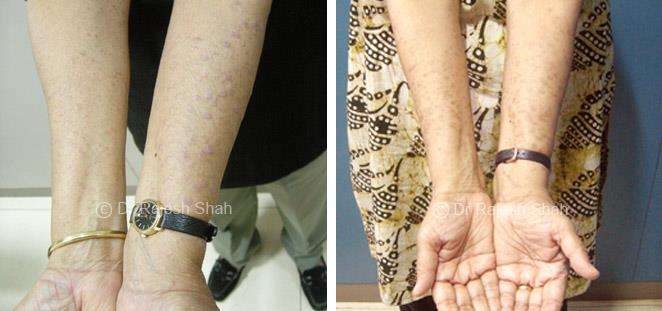 Lichen Planus Before and After Case Photo
