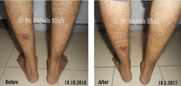 Psoriasis Before and After Case Photo