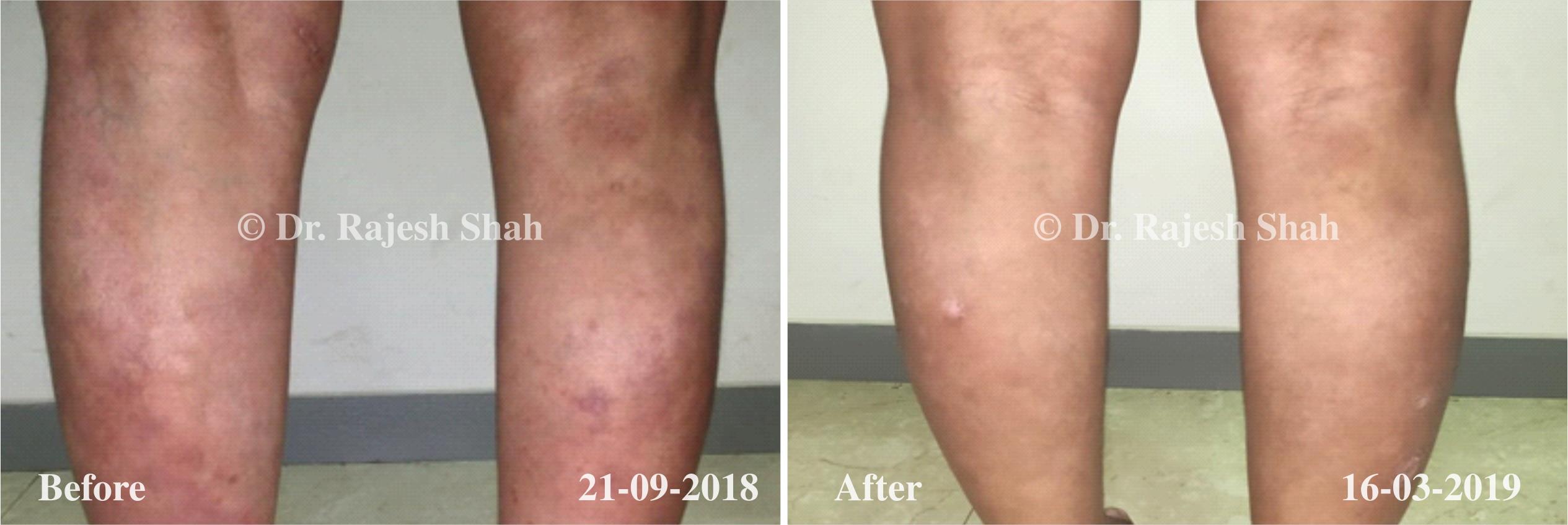 Psoriasis Before and After Case Photo