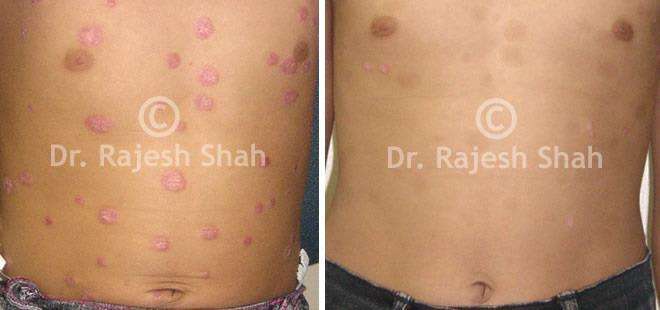 Psoriasis Before and After Case Photo