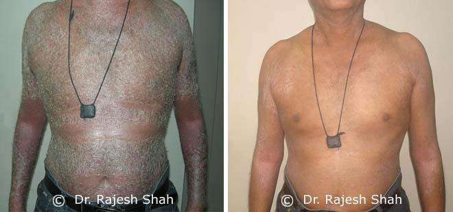 Psoriasis Before and After Case Photo