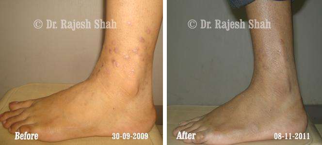 Lichen Planus Before and After Case Photo
