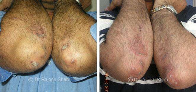 Psoriasis Before and After Case Photo