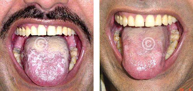 Lichen Planus Before and After Case Photo