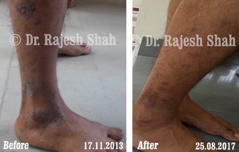Lichen Planus Before and After Case Photo