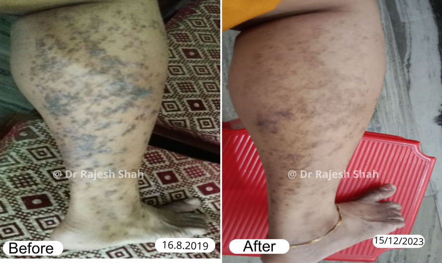 Lichen Planus Before and After Case Photo