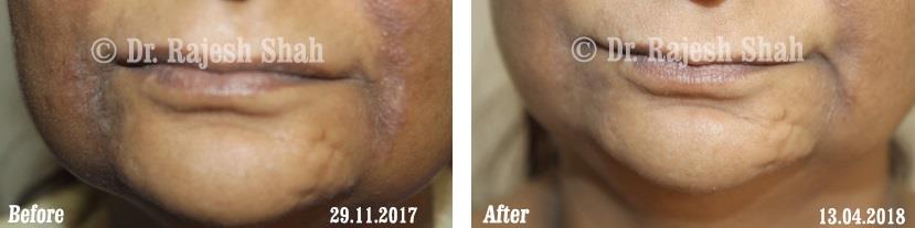 Eczema Before and After Case Photo