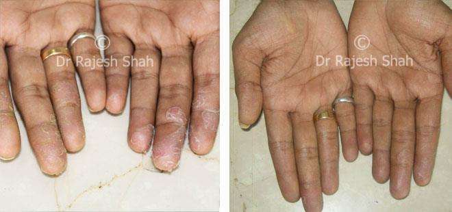 Psoriasis Before and After Case Photo