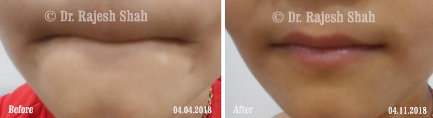 Vitiligo Before and After Case Photo