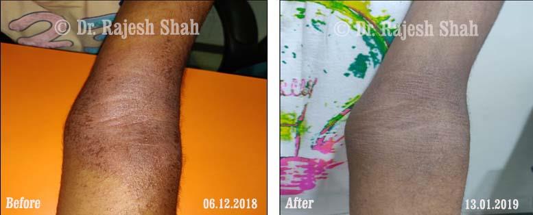 Atopic Dermatitis Before and After Case Photo