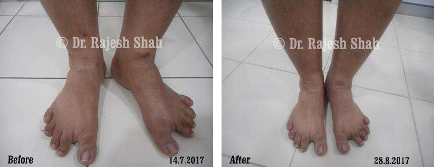 Atopic Dermatitis Before and After Case Photo