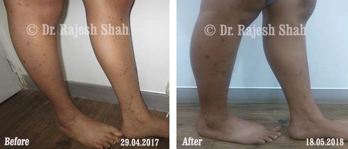 Lichen Planus Before and After Case Photo