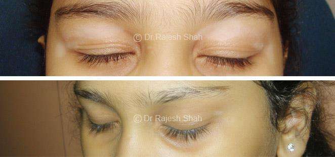 Vitiligo Before and After Case Photo