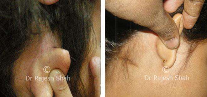 Vitiligo Before and After Case Photo