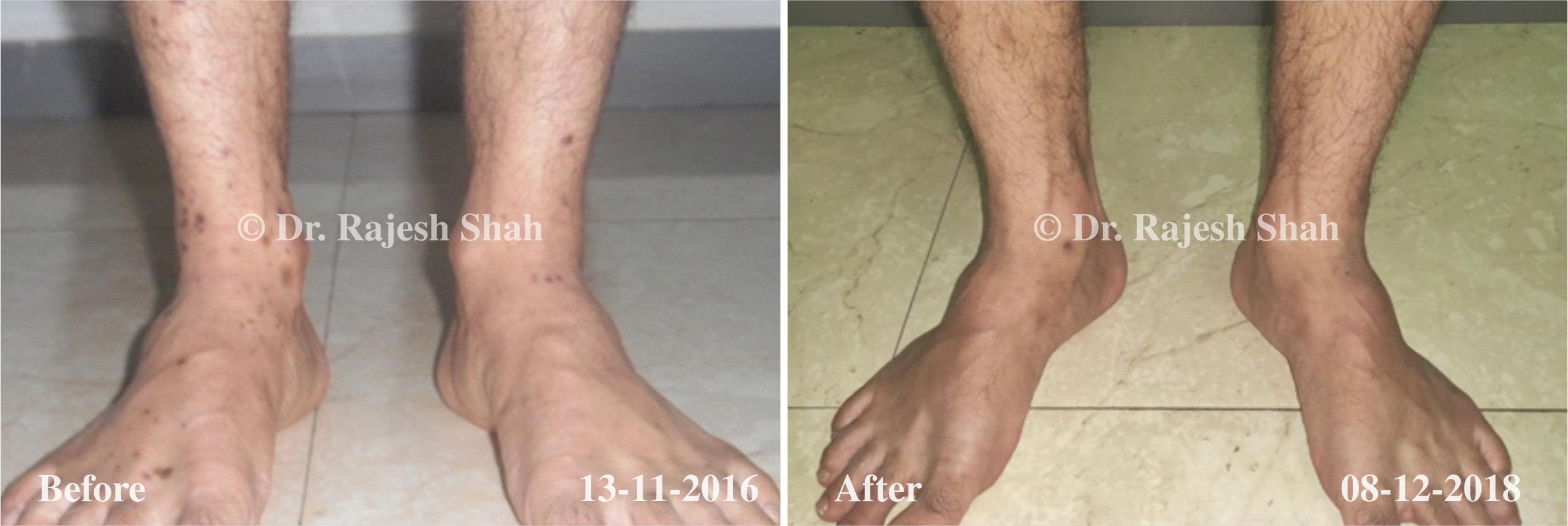 Lichen Planus Before and After Case Photo