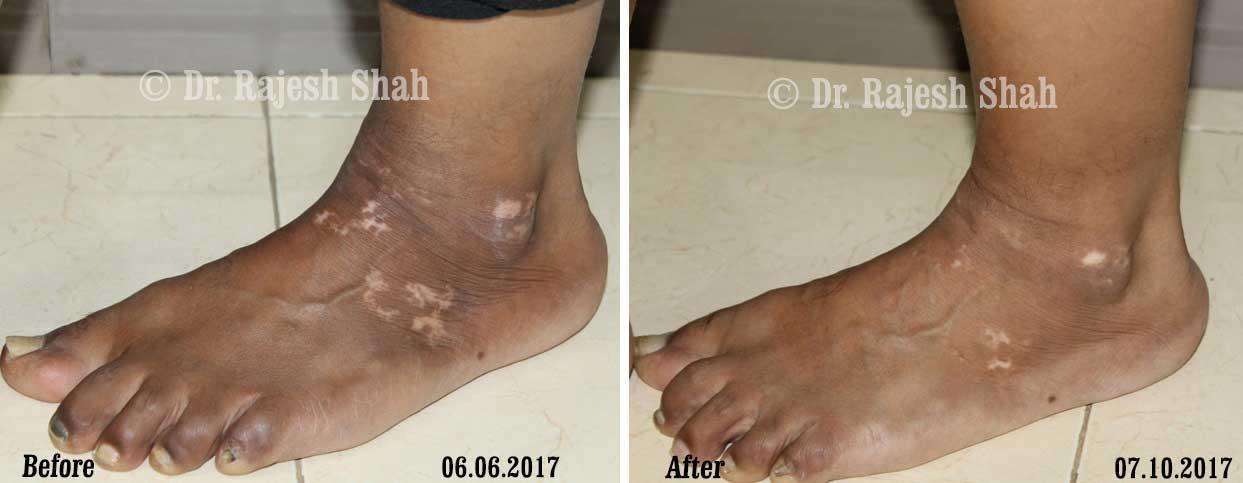 Vitiligo Before and After Case Photo