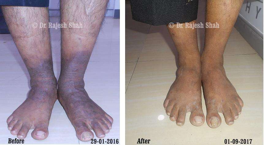 Eczema Before and After Case Photo