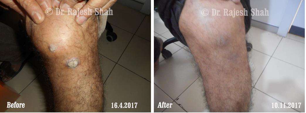 Psoriasis Before and After Case Photo