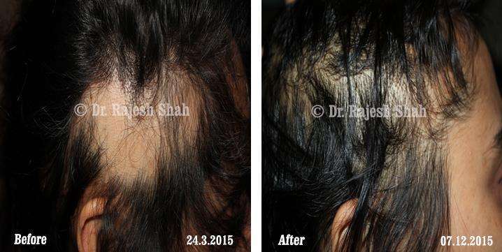 Alopecia Areata Before and After Case Photo