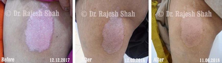 Psoriasis Before and After Case Photo