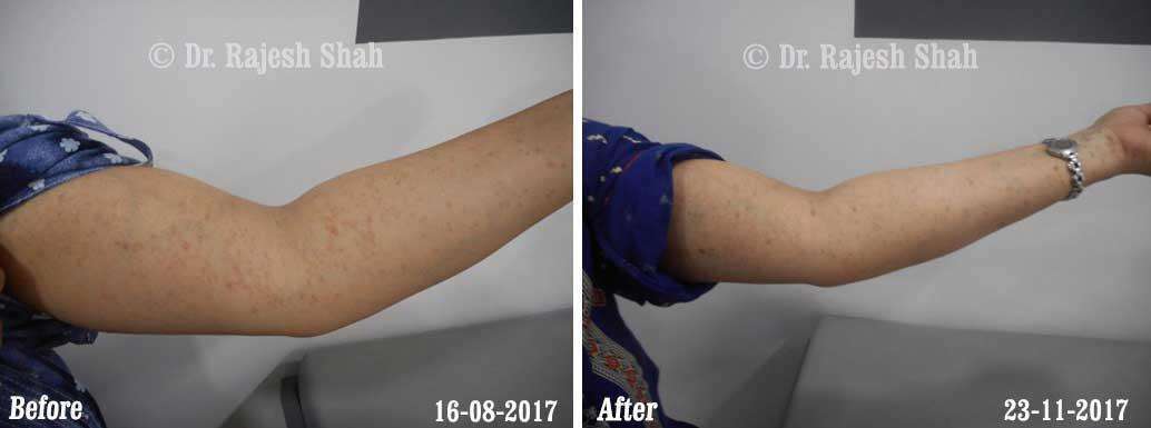 Lichen Planus Before and After Case Photo