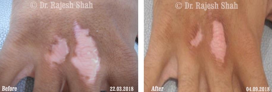 Vitiligo Before and After Case Photo