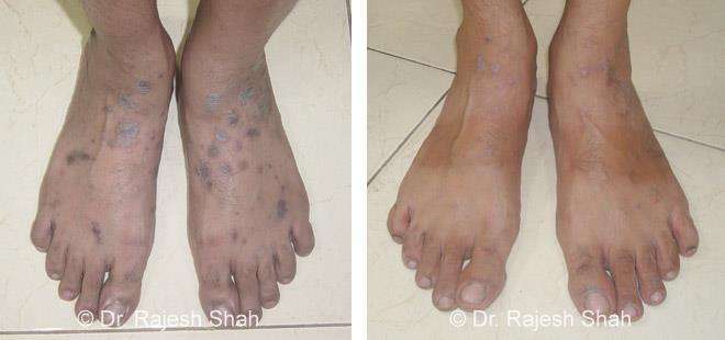 Lichen Planus Before and After Case Photo