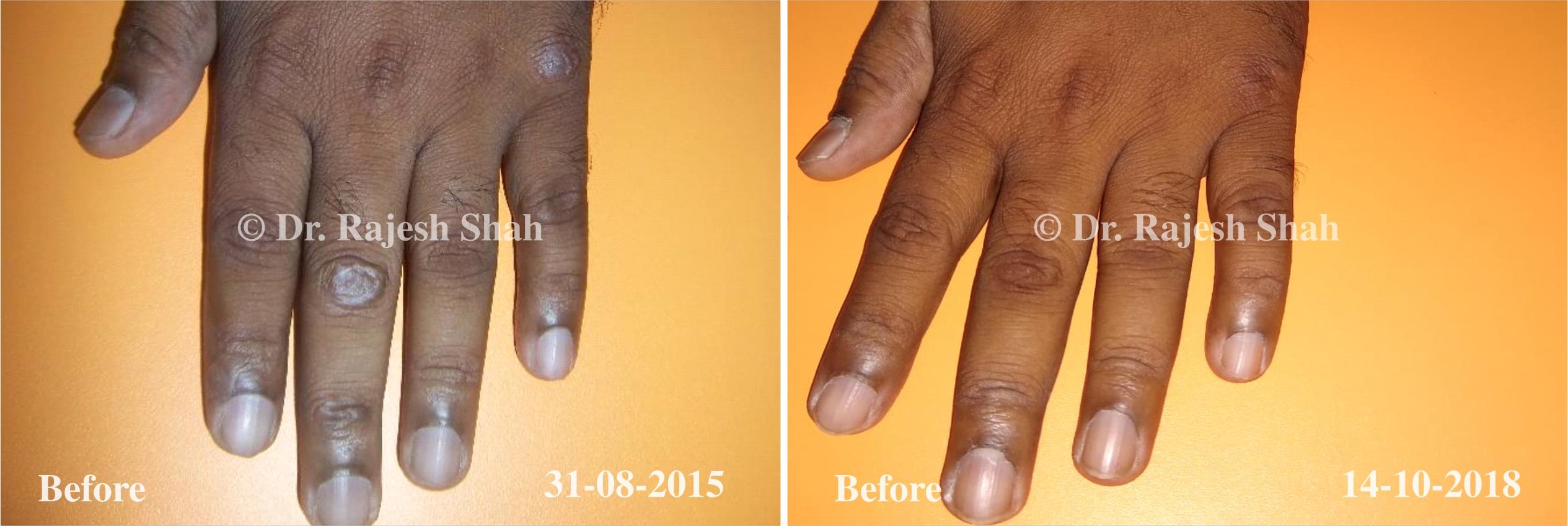 Vitiligo Before and After Case Photo