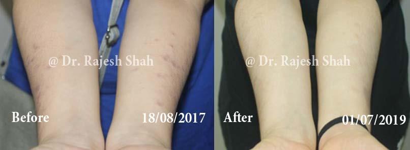 Lichen Planus Pigmentosa Before and After Case Photo