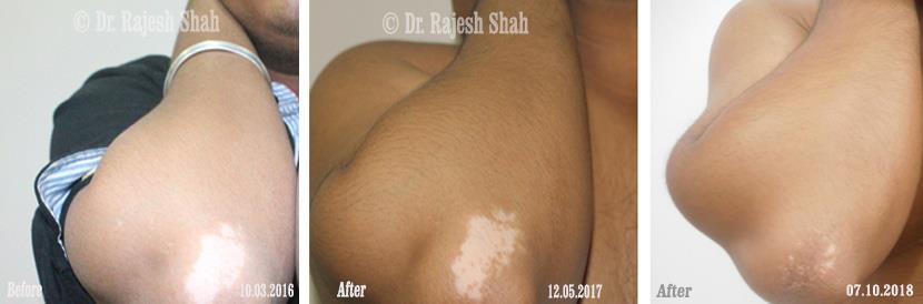 Vitiligo Before and After Case Photo