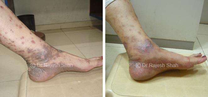 Lichen Planus Before and After Case Photo