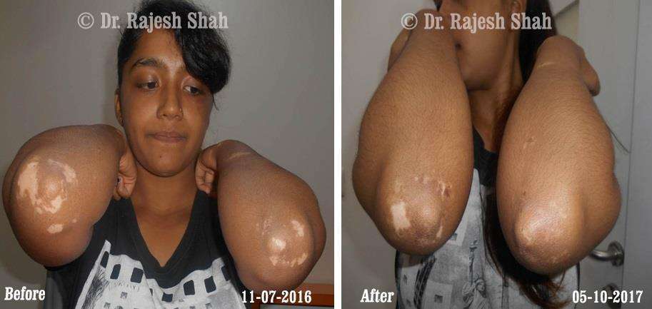 Vitiligo Before and After Case Photo