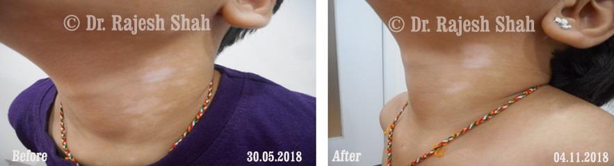 Vitiligo Before and After Case Photo