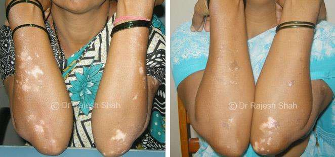 Vitiligo Before and After Case Photo