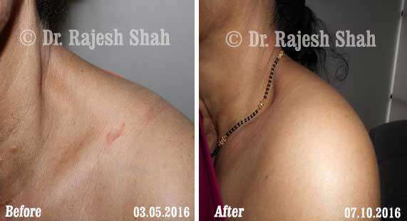 Granuloma Annulare Before and After Case Photo