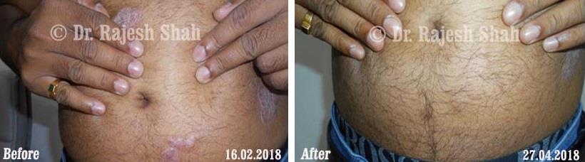 Psoriasis Before and After Case Photo