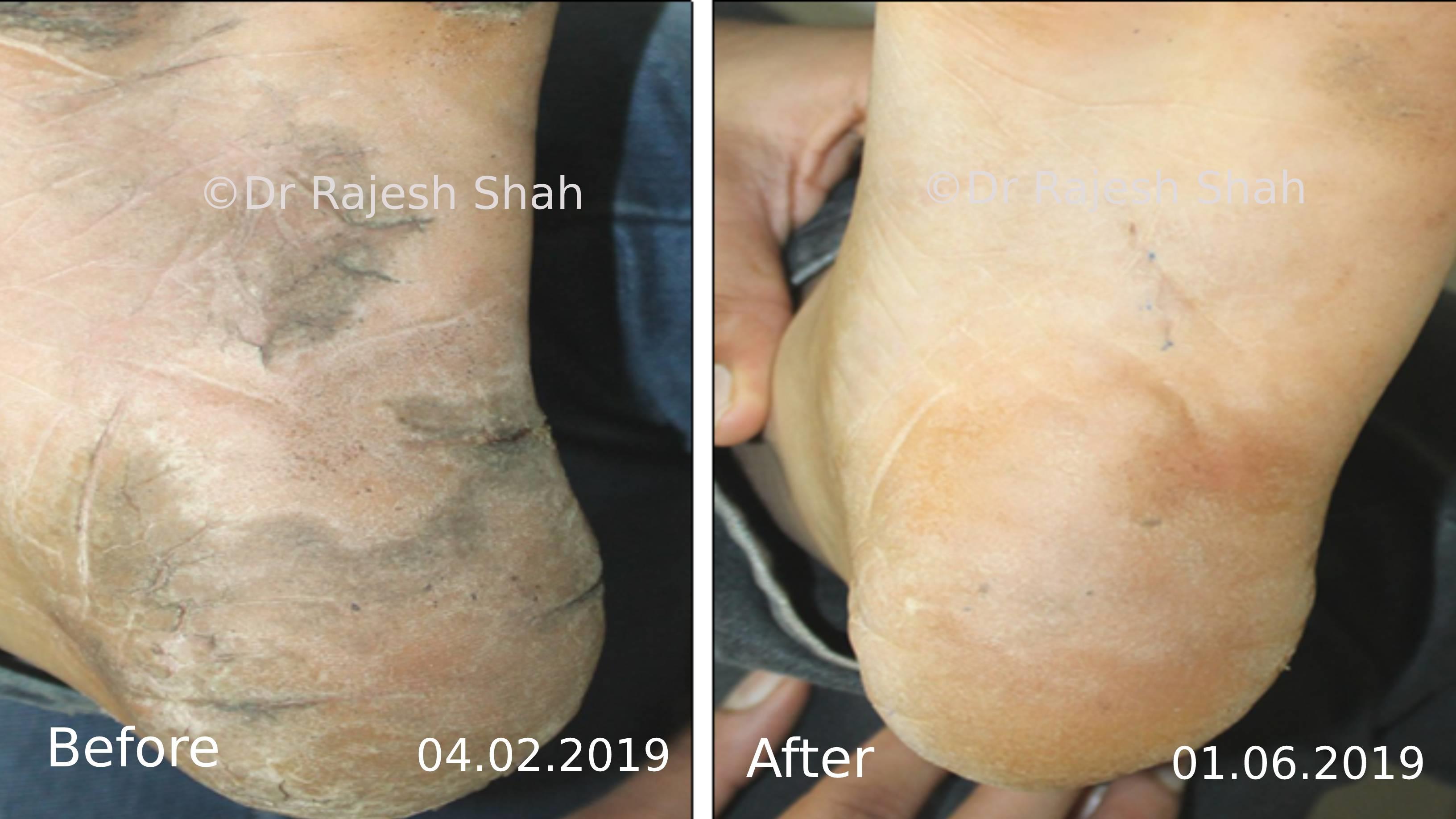 Psoriasis Before and After Case Photo