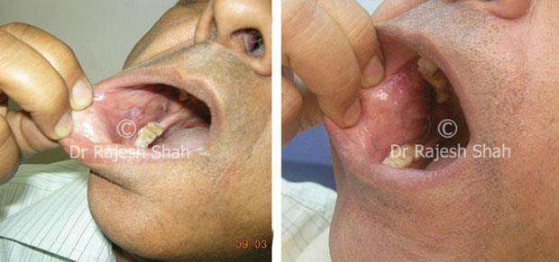 Lichen Planus Before and After Case Photo