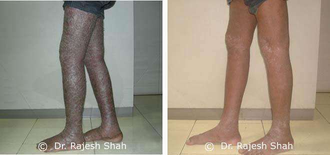 Psoriasis Before and After Case Photo