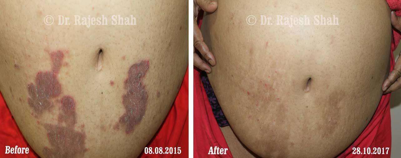 Psoriasis Before and After Case Photo