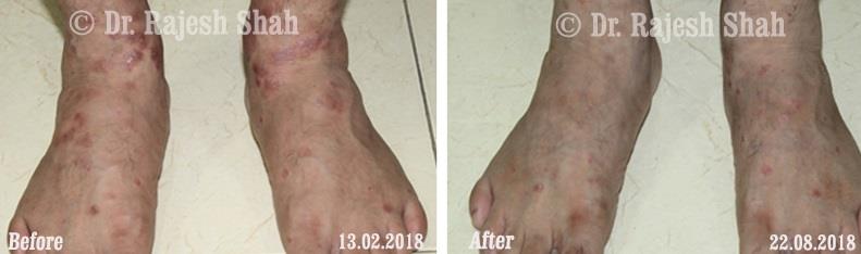 Psoriasis Before and After Case Photo