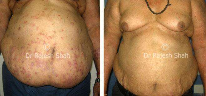 Psoriasis Before and After Case Photo