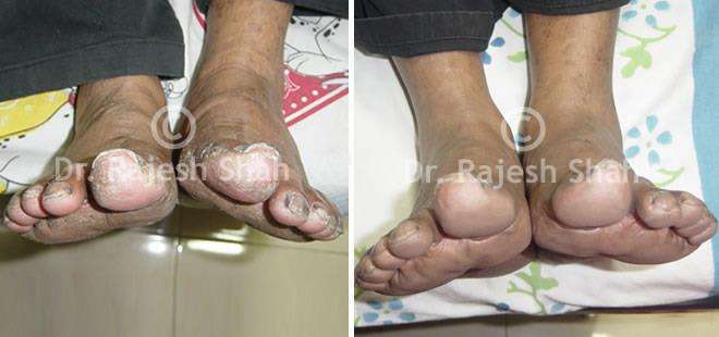 Psoriasis Before and After Case Photo