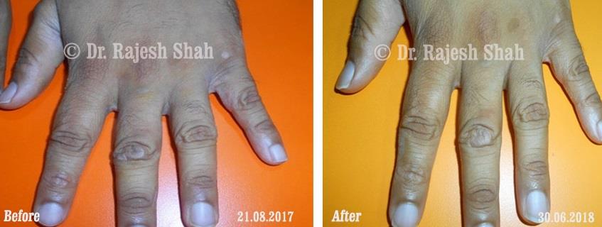 Psoriasis Before and After Case Photo